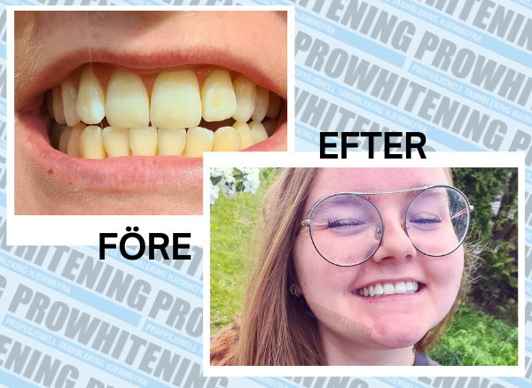 ProWhitening Strips