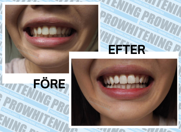 ProWhitening Strips